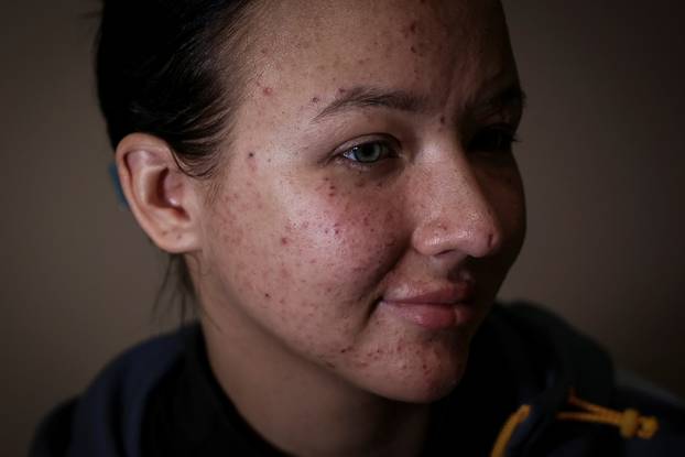 Former Ukrainian service member, who was wounded at a front line, comes to a clinic to treat scars, in Lviv
