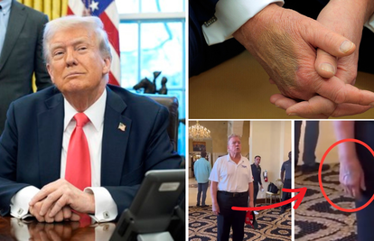 FOTO Trump ima veliku modricu na desnoj ruci. Bijela kuća tvrdi: 'To je od rukovanja, ne terapije'