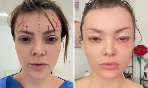 Ella Dvornik ispri&ccaron;ala detalje nove estetske operacije: 'Zaklamali su mi glavu...'