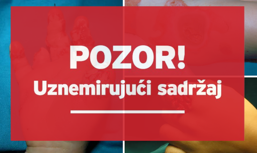 Strašne snimke iz Klaićeve. Evo zašto petarde ne davati djeci: Ostali bez prstiju, šake, vida!