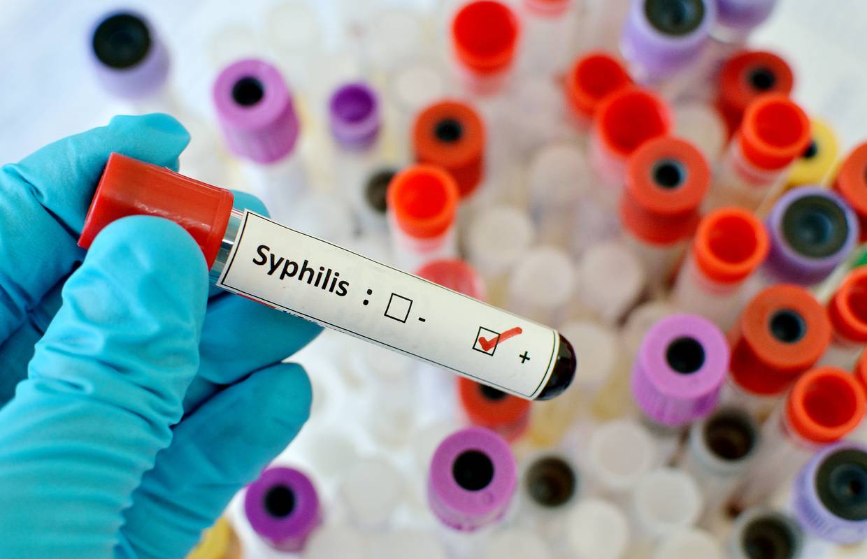 Sve više sifilisa, ali hrvatski liječnici poručuju: Bez panike...