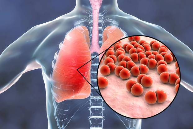 Pneumococcal,Pneumonia,,Medical,Concept.,3d,Illustration,Showing,Bacteria,Streptococcus,Pneumoniae