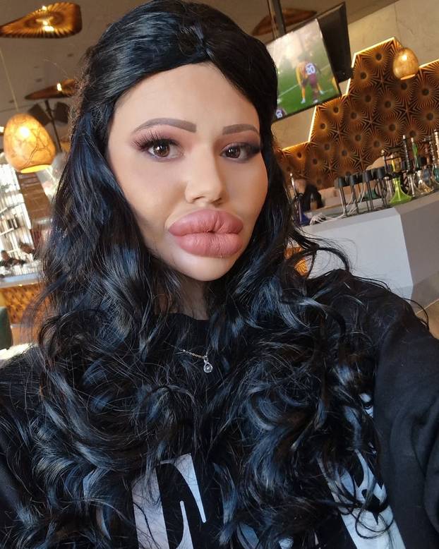 FOTO Žena s najvećim usnama na svijetu otkrila kako je nekoć izgledala: Šok! Bila si prekrasna