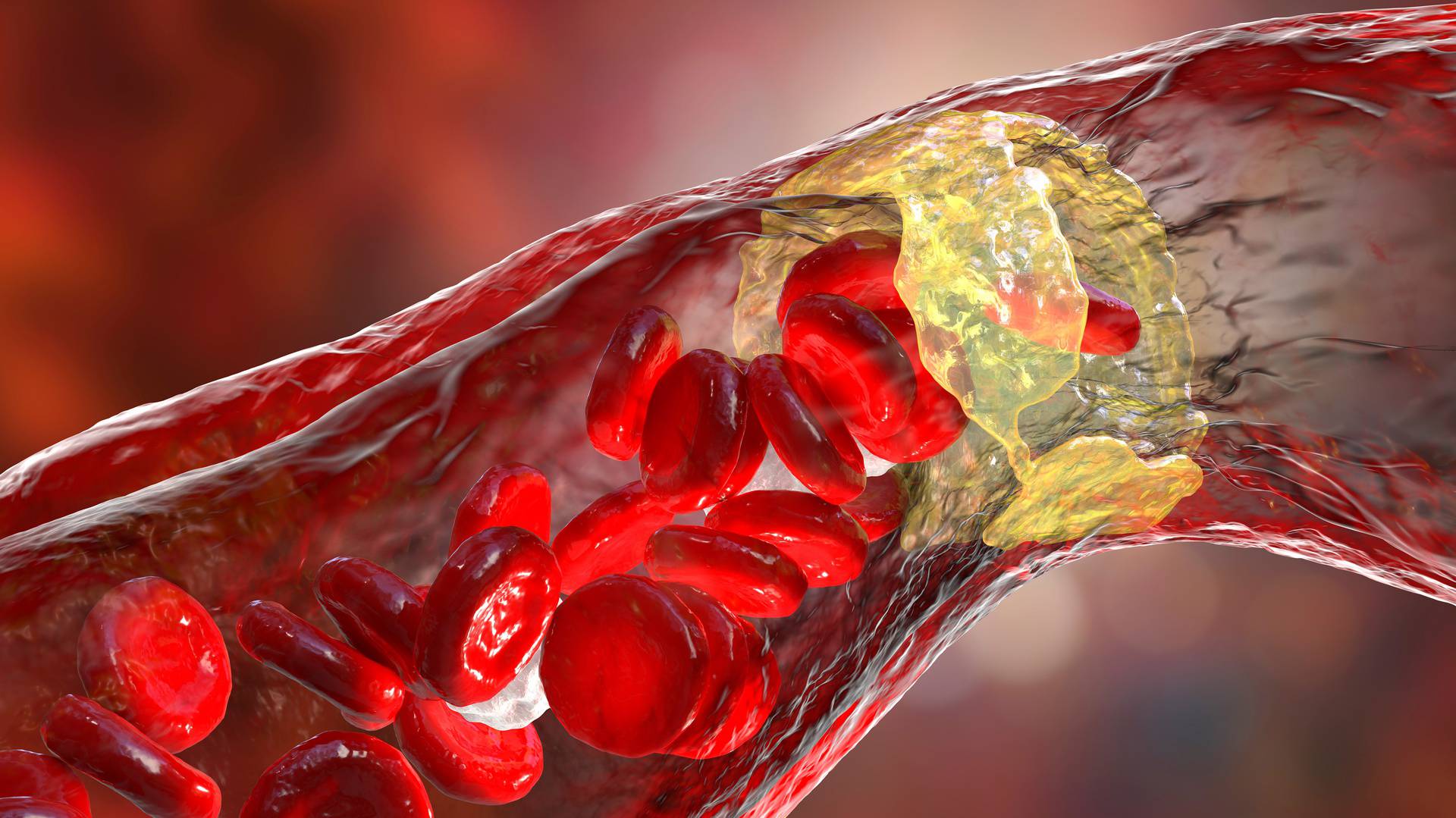 Atherosclerosis,,Atheromatous,Plaque,Inside,Artery,Leading,To,Narrowing,Of,Blood