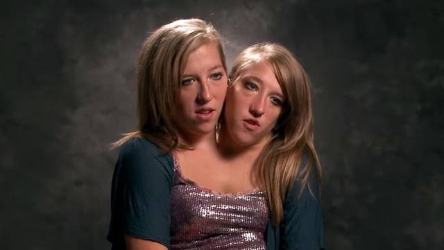 Sijamske blizanke sijamske blizanke Abigail i Brittany Hensel