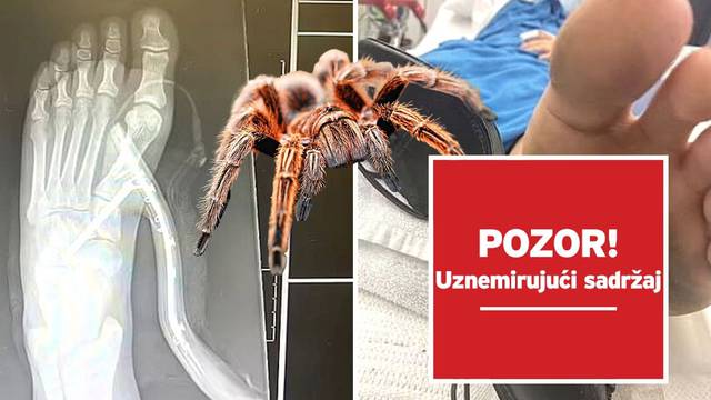 Vidjela pauka i skočila na štiklu, peta joj ušla u nogu! Doktori su bili u čudu: 'Kako ste to uspjeli?'