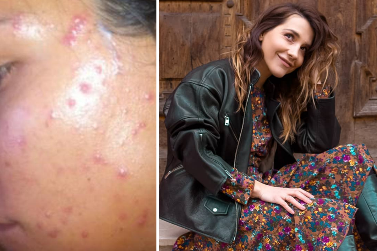 Batinić objavila fotke s aknama: 'Ako sam samo jednoj djevojci ovime pomogla, presretna sam'