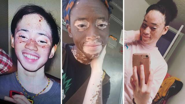 Žena tvrdi da je uspjela vitiligo izliječiti veganskom prehranom