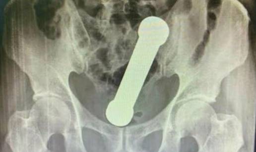 PA KAKO? Doktori mu iz anusa izvadili uteg od dva kilograma