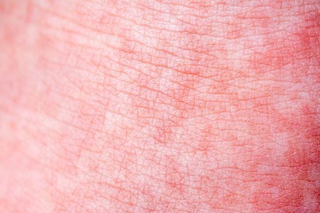 Scarlet Fever starts with a red rush and the strawberry tongue Afterwards the affected skin often peels - Here red skin rush