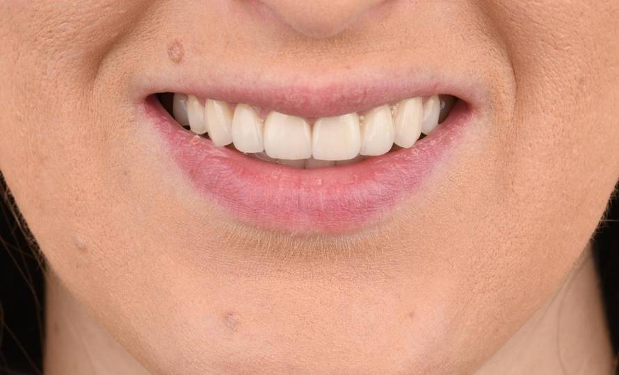 Kako izgleda proces ugradnje dentalnih ljuskica?