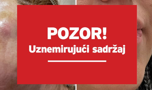 Šokantne fotke žena koje je zagrebački kirurg unakazio: 'Patimo od bolova i traume...'