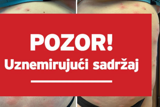 Ženu izjele stjenice: 'U hotelu u Zagrebu su me izgrizle, svrab je nepodnošljiv, ne mogu spavati'
