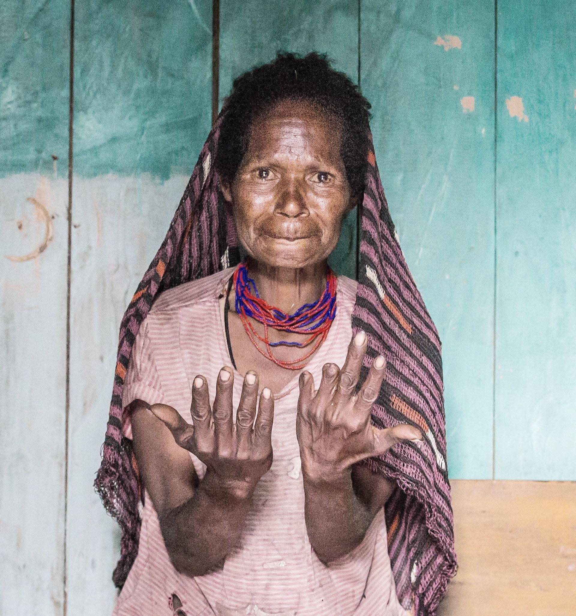 Missing fingers. Dani tribe ladies cut off their fingers to demonstrate their pain at the loss of a younger family member. West Papua, Indonesia