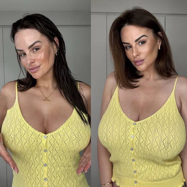 FOTO Poznata manekenka otišla na operaciju smanjenja grudi: 'Najbolja odluka u mom životu!'