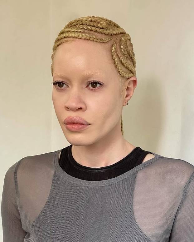 FOTO Afrikanka s albinizmom osvaja modnu industriju: 'Često privlačim znatiželjne poglede'