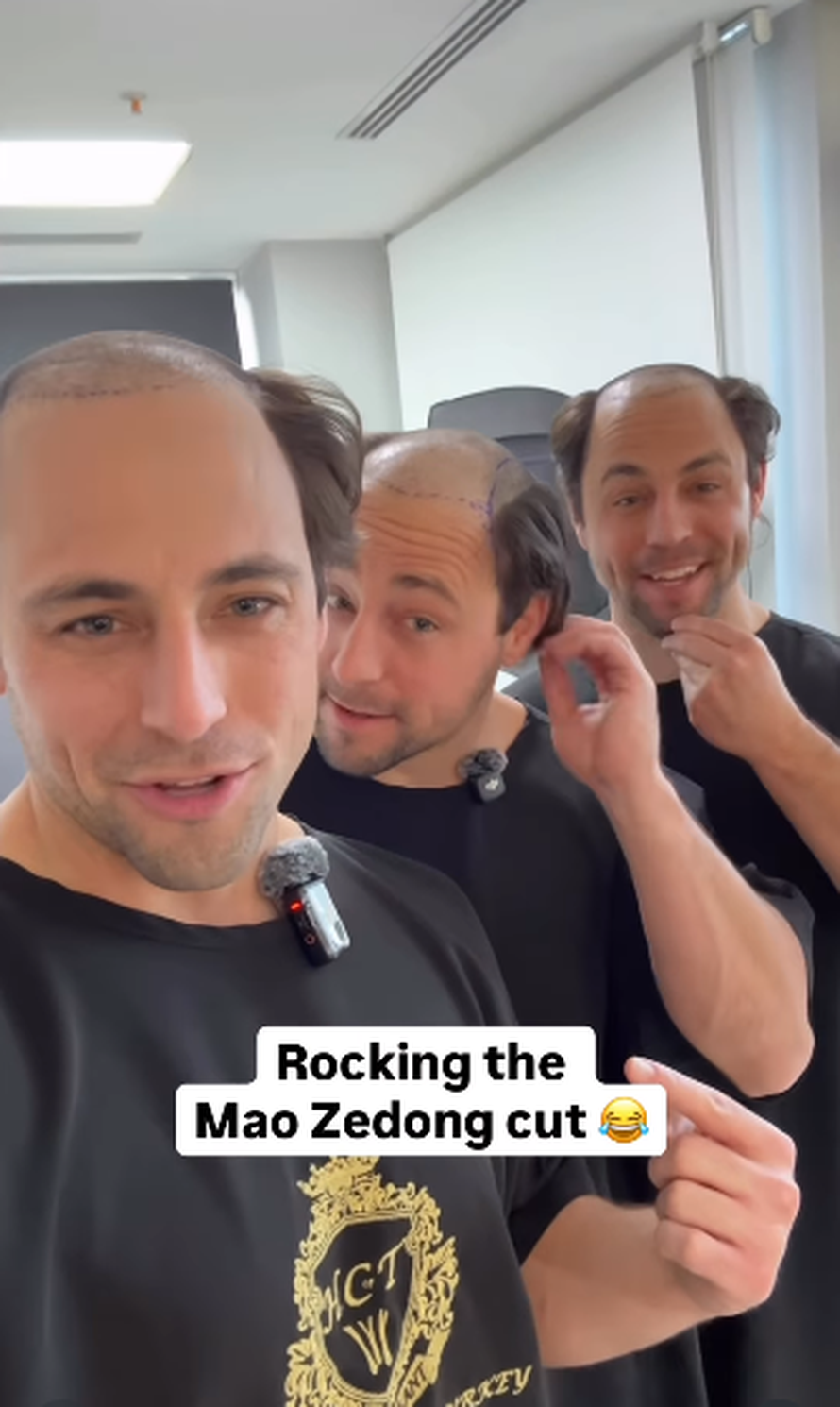 Trojčeki otputovali u Tursku na transplantaciju kose: 'Ne može samo jedan imati dobru frizuru'