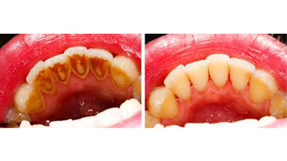 Riješite se zubnog kamenca bezbolno iz udobnosti doma