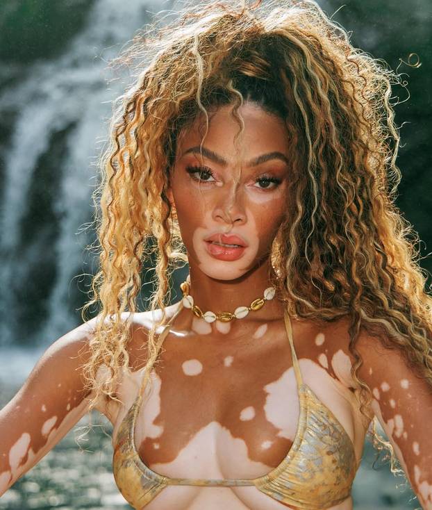 FOTO Rugali su joj se zbog bolesti, a danas je obožavaju zbog jedinstvenog izgleda