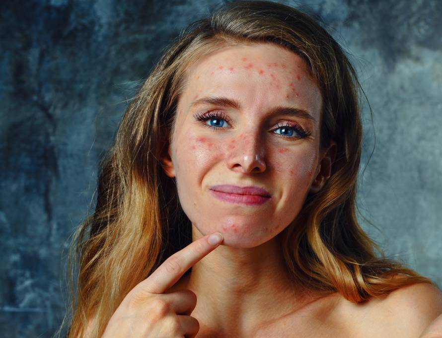 Ovih osam simptoma znači da imate neku alergijsku reakciju