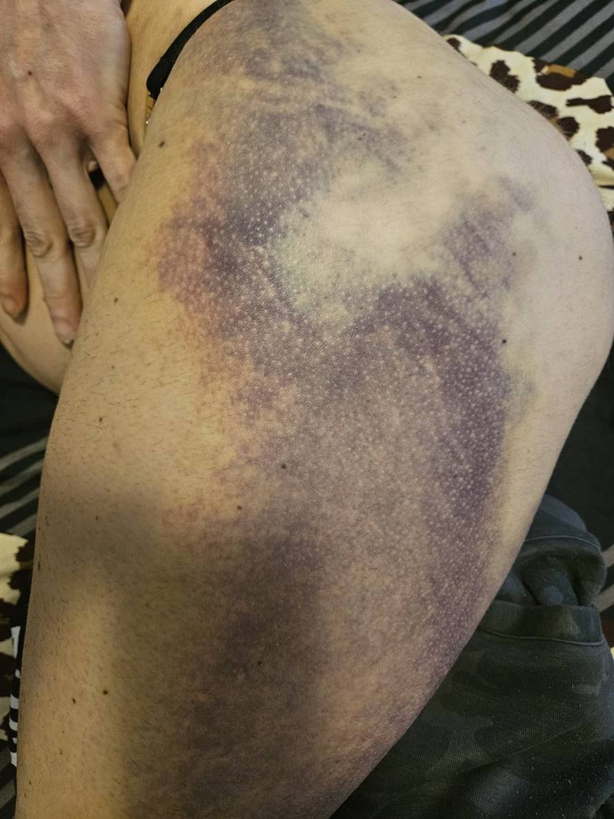 Super Silva za 24sata: Znam tko me napao, bilo je iznenada i s leđa. Jedna noga mi je uništena