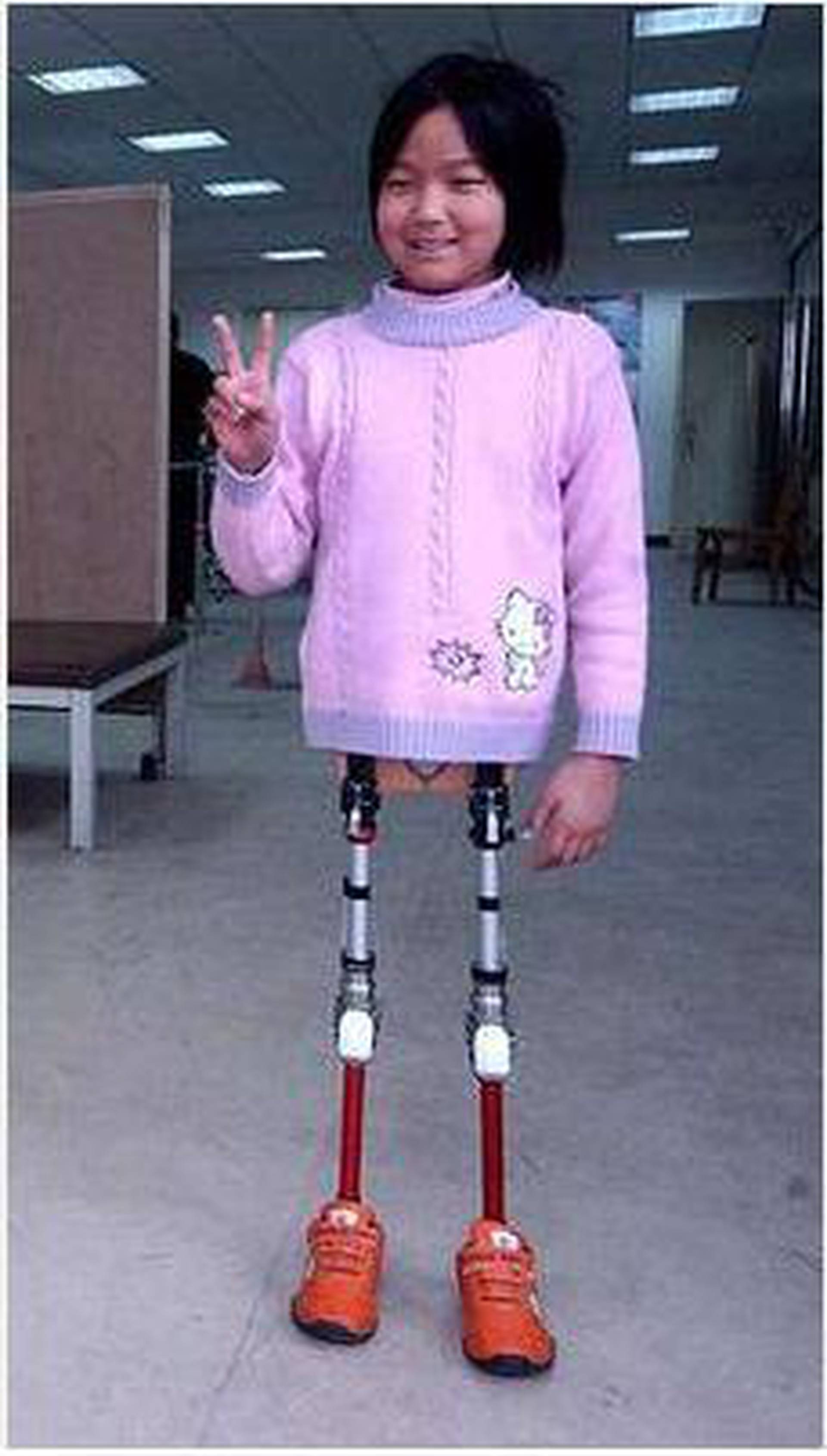 Родилась без ноги. Дети инвалиды без конечностей.