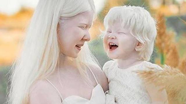Predivne albino sestre osvajaju svijet, izgledaju kao dva anđela