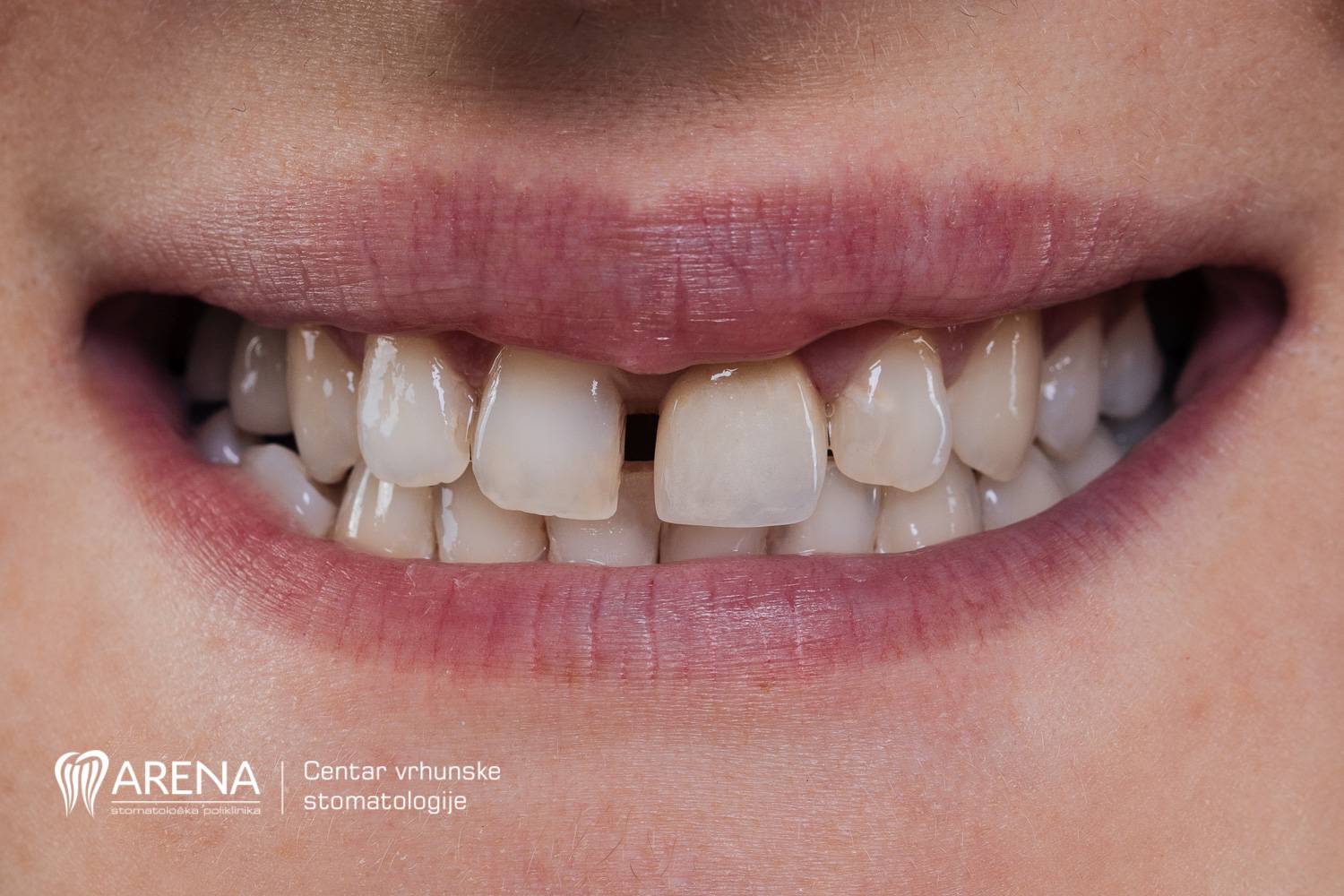 Znate li kako riješiti razmak između zubi?