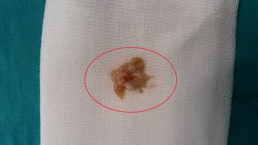 Mislili su da je upala: Dječaku gumeni bombon zalijepio pluća