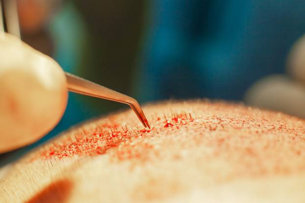 Macrophotography of a hair bulb transplanted into a hairless area. Baldness treatment. Hair transplant. Surgeons in the operating room carry out hair transplant surgery. Surgical technique that moves hair follicles from a part of the head.