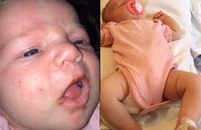 Beba jedva preživjela herpes: 'Ne dajte da svatko ljubi dijete'