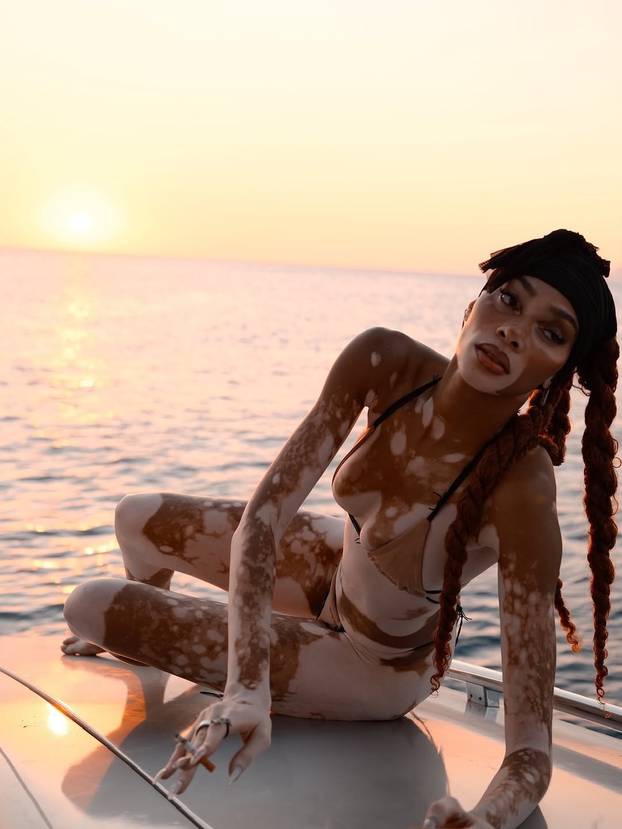 FOTO Rugali su joj se zbog bolesti, a danas je obožavaju zbog jedinstvenog izgleda