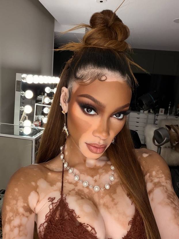 FOTO Rugali su joj se zbog bolesti, a danas je obožavaju zbog jedinstvenog izgleda