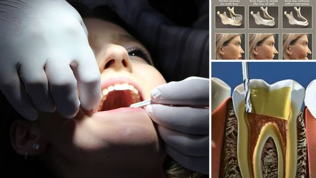 Pogledajte što zubar zapravo radi dok popravlja zube i kako se lice mijenja kad zubi ispadnu