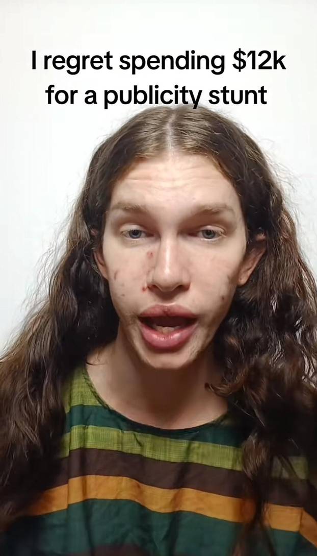 FOTO Htjela je biti žena mačka, a sad plače: Dala sam 7000 €, a fileri su me unakazili! Pomiču se