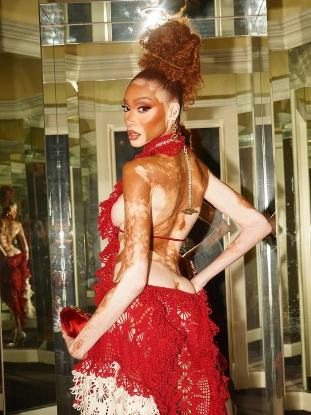 FOTO Rugali su joj se zbog bolesti, a danas je obožavaju zbog jedinstvenog izgleda