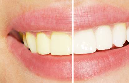 Šest je razloga zbog kojih zubi postaju žuti, evo kako si pomoći