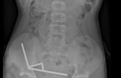 Dječak (13) progutao stotinu magneta koje je kupio online. Oglasili su se s Temua