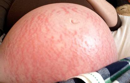 Alergična na trudnoću: Dobila osip, ali je rodila zdravu bebu