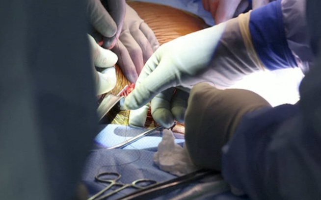 VIDEO Ovo je prvi čovjek kojem je transplantiran bubreg svinje: 'Godinama sam ovo želio...'