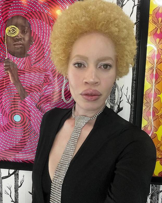 FOTO Afrikanka s albinizmom osvaja modnu industriju: 'Često privlačim znatiželjne poglede'