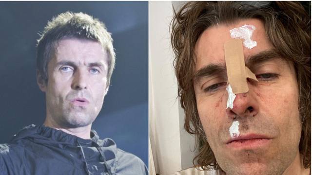 Liam Gallagher u masnicama nakon pada iz helikoptera: 'Sad imam fotku za cover albuma'