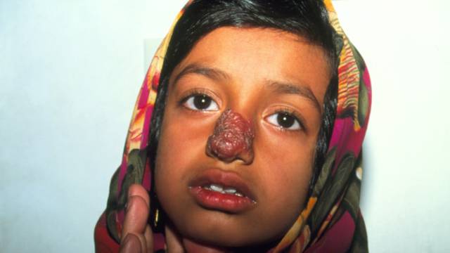 Cutaneous leishmaniasis lesion on a girl's face