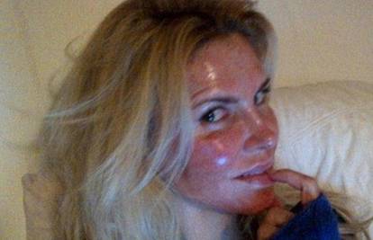 'Spržila' si lice laserom pa je fotografiju objavila na Twitteru