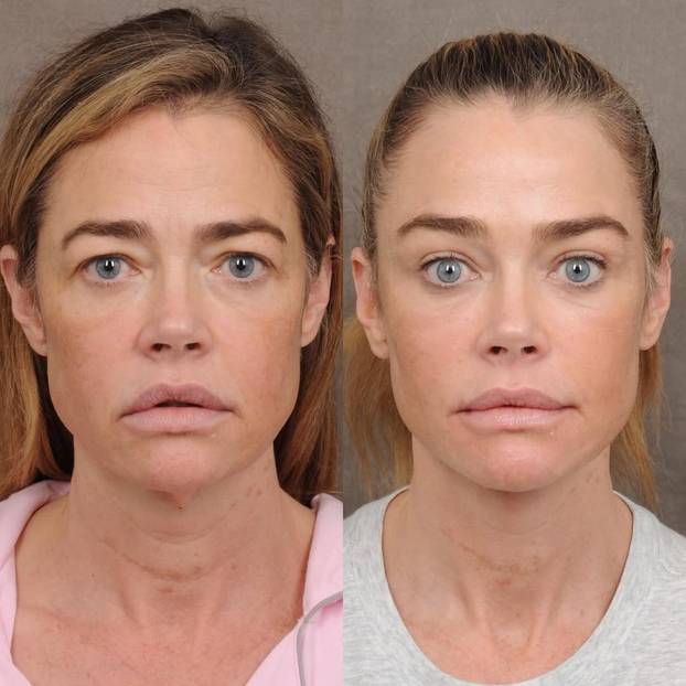 Denise Richards na faceliftingu: Sheenova bivša pokazala je fotke prije i poslije zahvata
