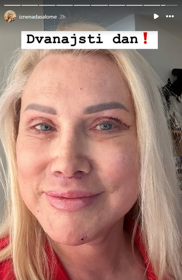 FOTO Prva je u Hrvatskoj pričala o promjeni spola: Salome je išla na facelifting, evo kako izgleda