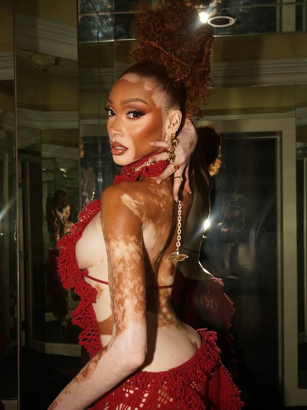 FOTO Rugali su joj se zbog bolesti, a danas je obožavaju zbog jedinstvenog izgleda