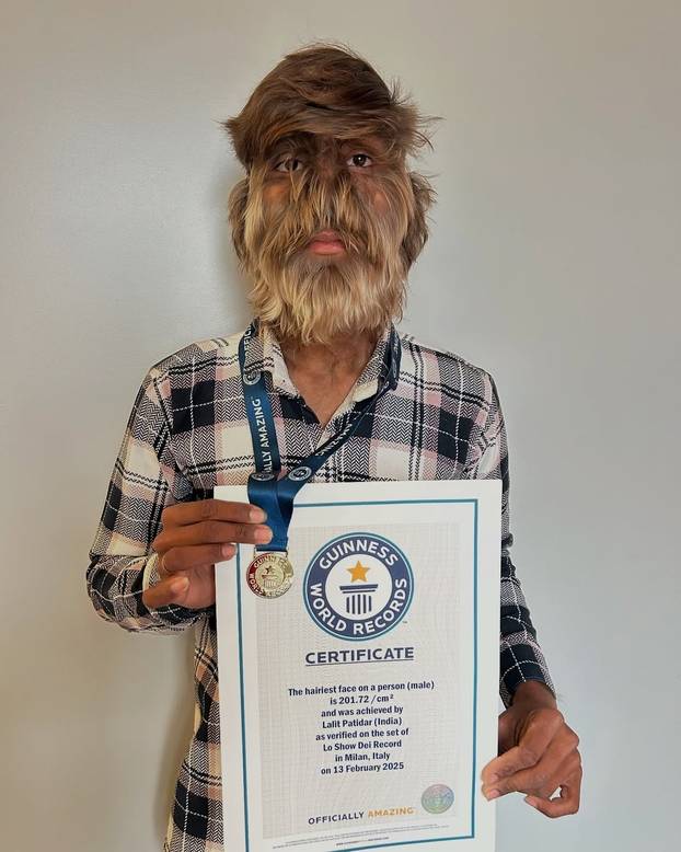 FOTO Ovaj mladić (18) pati od sindroma vukodlaka: U školi me sprdaju, ali volim svoje dlake...