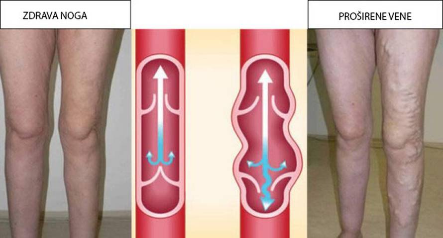 Svaka 2. hrvatica pati od proširenih vena! Poduzmite nešto