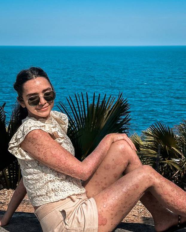 EXCLUSIVE: ‘95% of my skin is covered by psoriasis but I’ll never hide my body,’ says woman, 22